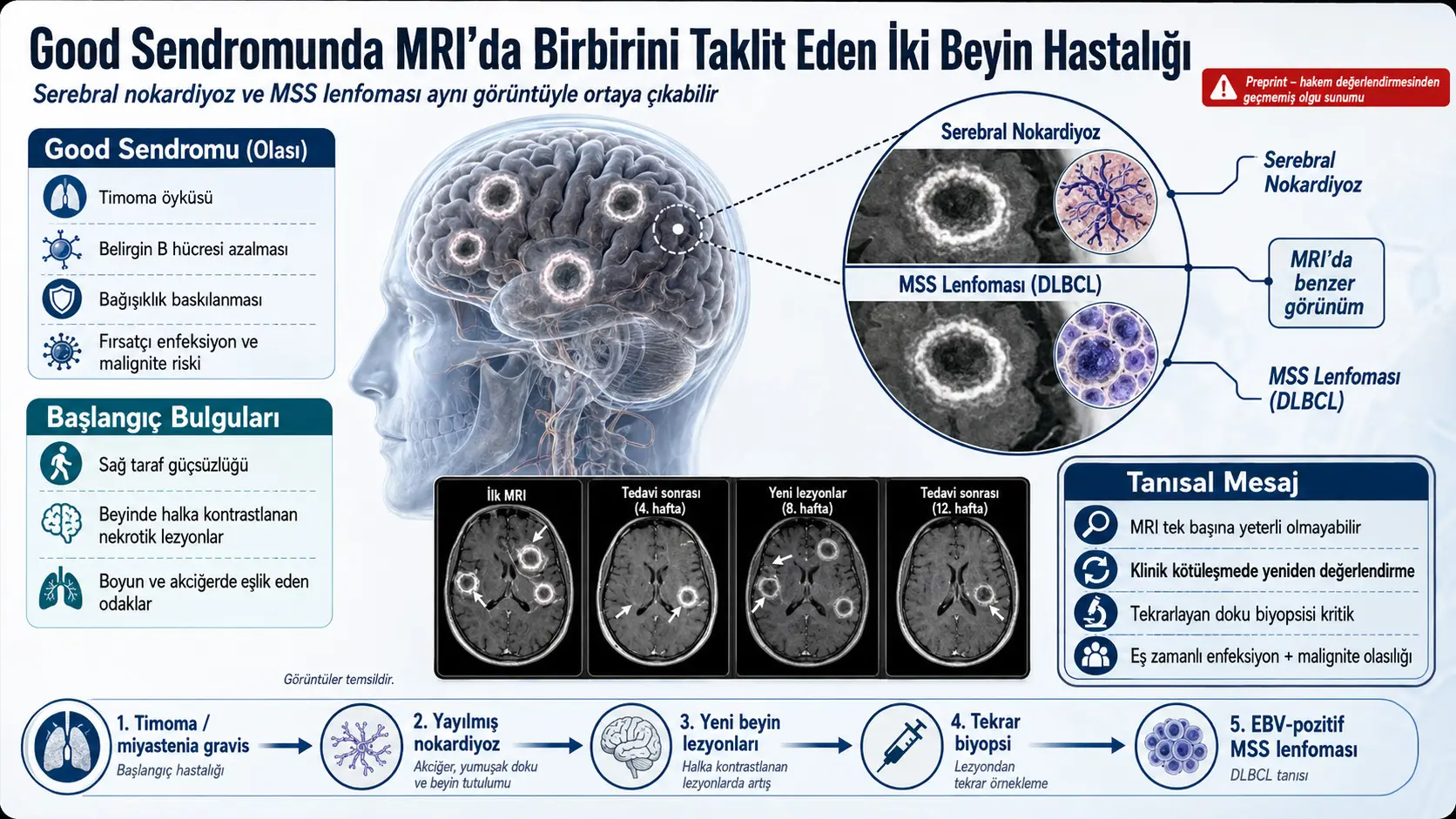 Good sindromida bir xil MRI koʻrinishini namoyon qilgan ikki alohida miya kasalligi: serebral nokardioz va markaziy asab tizimi limfomasi