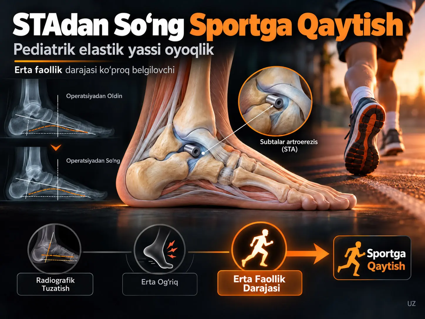 Pediatrik Elastik Yassi Oyoqlikda Subtalar Artroerezisdan Soʻng Sportga Qaytish: Radiografik Tuzatish va Qoldiq Ogʻriq Mustaqil Bashoratlovchilar Emas